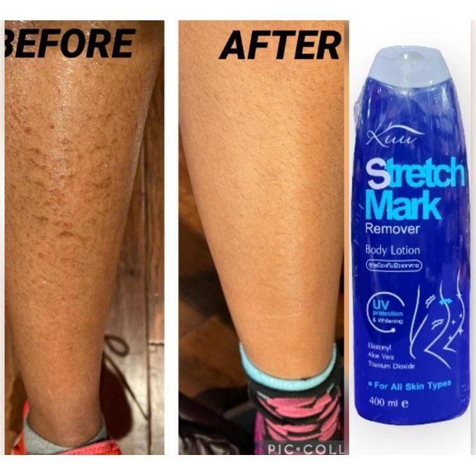 Home kuu stretchmark remover lotion 400ml
